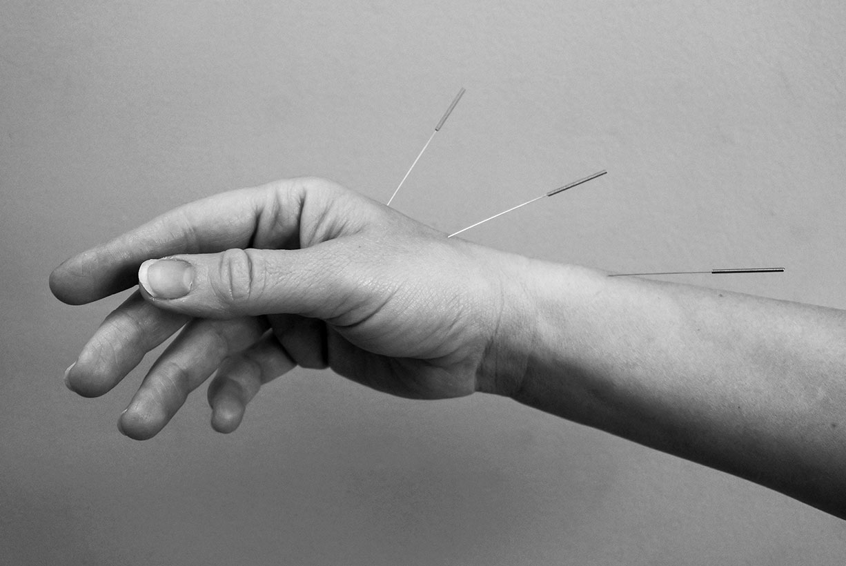 Acupuncture treatment